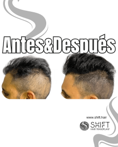 Antes y después de una micropigmentación capilar para un camuflaje de densidad en Turquía en SHIFT Hair en Estambul 13 3