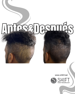 Antes y después de una micropigmentación capilar para un camuflaje de densidad en Turquía en SHIFT Hair en Estambul 15 3