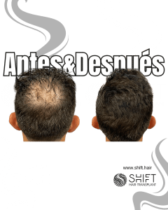 Antes y después de una micropigmentación capilar para un camuflaje de densidad en Turquía en SHIFT Hair en Estambul 18 3