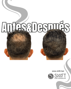 Antes y después de una micropigmentación capilar para un camuflaje de densidad en Turquía en SHIFT Hair en Estambul 19 3