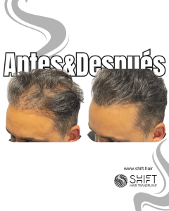 Antes y después de una micropigmentación capilar para un camuflaje de densidad en Turquía en SHIFT Hair en Estambul 22 3