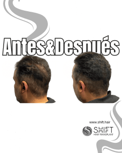 Antes y después de una micropigmentación capilar para un camuflaje de densidad en Turquía en SHIFT Hair en Estambul 25 3