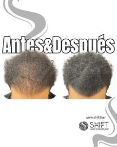 Antes y después de una micropigmentación capilar para un camuflaje de densidad en Turquía en SHIFT Hair en Estambul 29 3