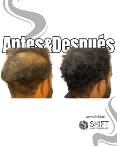 Antes y después de una micropigmentación capilar para un camuflaje de densidad en Turquía en SHIFT Hair en Estambul 32 3