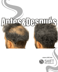 Antes y después de una micropigmentación capilar para un camuflaje de densidad en Turquía en SHIFT Hair en Estambul 33 3