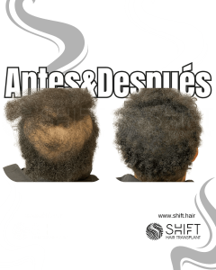 Antes y después de una micropigmentación capilar para un camuflaje de densidad en Turquía en SHIFT Hair en Estambul 34 3