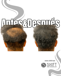 Antes y después de una micropigmentación capilar para un camuflaje de densidad en Turquía en SHIFT Hair en Estambul 35 3