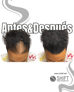 Antes y después de una micropigmentación capilar para un camuflaje de densidad en Turquía en SHIFT Hair en Estambul 37 3