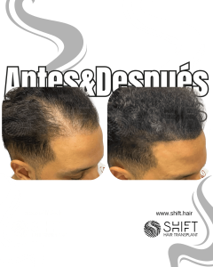 Antes y después de una micropigmentación capilar para un camuflaje de densidad en Turquía en SHIFT Hair en Estambul 38 3