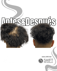 Antes y después de una micropigmentación capilar para un camuflaje de densidad en Turquía en SHIFT Hair en Estambul 40 3