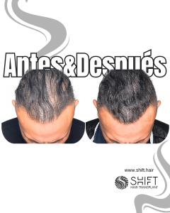 Antes y después de una micropigmentación capilar para un camuflaje de densidad en Turquía en SHIFT Hair en Estambul 42 3