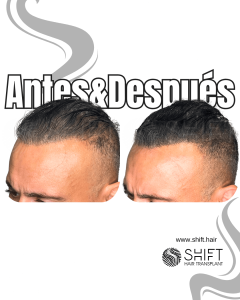 Antes y después de una micropigmentación capilar para un camuflaje de densidad en Turquía en SHIFT Hair en Estambul 44 3