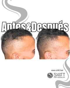 Antes y después de una micropigmentación capilar para un camuflaje de densidad en Turquía en SHIFT Hair en Estambul 45 3