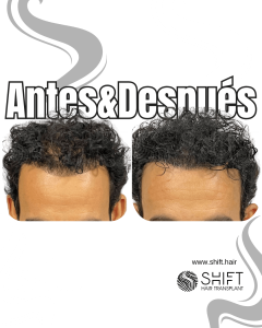 Antes y después de una micropigmentación capilar para un camuflaje de densidad en Turquía en SHIFT Hair en Estambul 47 3