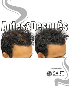 Antes y después de una micropigmentación capilar para un camuflaje de densidad en Turquía en SHIFT Hair en Estambul 49 3
