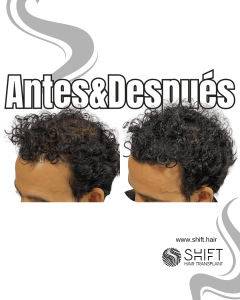 Antes y después de una micropigmentación capilar para un camuflaje de densidad en Turquía en SHIFT Hair en Estambul 50 3