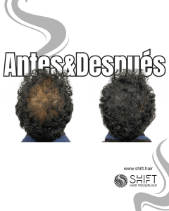 Antes y después de una micropigmentación capilar para un camuflaje de densidad en Turquía en SHIFT Hair en Estambul 51 3