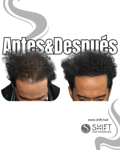 Antes y después de una micropigmentación capilar para un camuflaje de densidad en Turquía en SHIFT Hair en Estambul 53 3