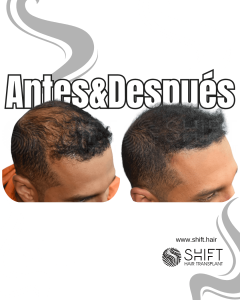 Antes y después de una micropigmentación capilar para un camuflaje de densidad en Turquía en SHIFT Hair en Estambul 56 3