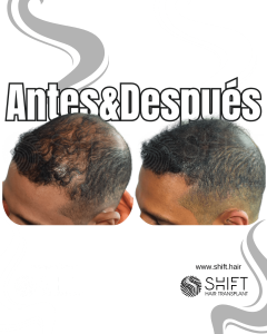 Antes y después de una micropigmentación capilar para un camuflaje de densidad en Turquía en SHIFT Hair en Estambul 57 3