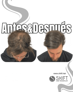 Antes y después de una micropigmentación capilar para un camuflaje de densidad en Turquía en SHIFT Hair en Estambul 58 3