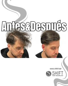 Antes y después de una micropigmentación capilar para un camuflaje de densidad en Turquía en SHIFT Hair en Estambul 59 3