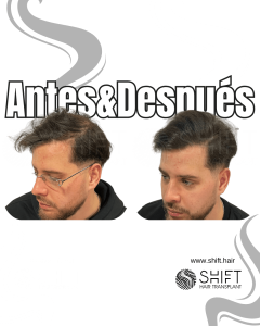 Antes y después de una micropigmentación capilar para un camuflaje de densidad en Turquía en SHIFT Hair en Estambul 60 3