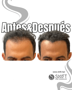 Antes y después de una micropigmentación capilar para un camuflaje de densidad en Turquía en SHIFT Hair en Estambul 61 3