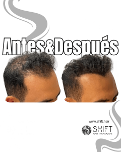 Antes y después de una micropigmentación capilar para un camuflaje de densidad en Turquía en SHIFT Hair en Estambul 62 3