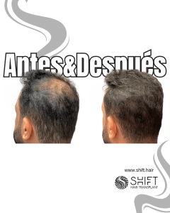 Antes y después de una micropigmentación capilar para un camuflaje de densidad en Turquía en SHIFT Hair en Estambul 64 3