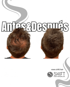 Antes y después de una micropigmentación capilar para un camuflaje de densidad en Turquía en SHIFT Hair en Estambul 70 3