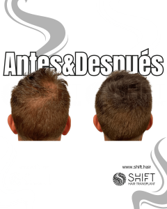 Antes y después de una micropigmentación capilar para un camuflaje de densidad en Turquía en SHIFT Hair en Estambul 71 3