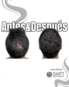 Antes y después de una micropigmentación capilar para un camuflaje de densidad en Turquía en SHIFT Hair en Estambul 76 3