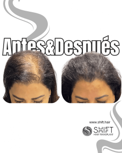Antes y después de una micropigmentación capilar para un camuflaje de densidad o mujeres en Turquía en SHIFT Hair en Estambul 01 3