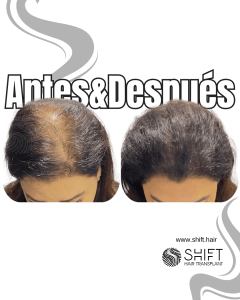 Antes y después de una micropigmentación capilar para un camuflaje de densidad o mujeres en Turquía en SHIFT Hair en Estambul 02 3