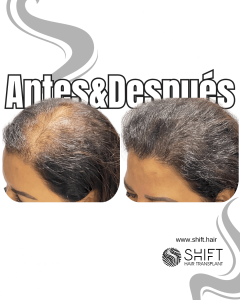 Antes y después de una micropigmentación capilar para un camuflaje de densidad o mujeres en Turquía en SHIFT Hair en Estambul 04 3