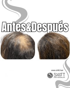 Antes y después de una micropigmentación capilar para un camuflaje de densidad o mujeres en Turquía en SHIFT Hair en Estambul 07 3