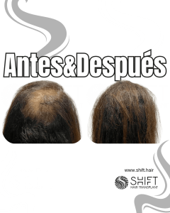 Antes y después de una micropigmentación capilar para un camuflaje de densidad o mujeres en Turquía en SHIFT Hair en Estambul 08 3