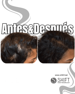 Antes y después de una micropigmentación capilar para un camuflaje de densidad o mujeres en Turquía en SHIFT Hair en Estambul 10 3