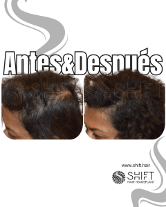 Antes y después de una micropigmentación capilar para un camuflaje de densidad o mujeres en Turquía en SHIFT Hair en Estambul 11 3