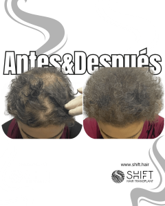 Antes y después de una micropigmentación capilar para un camuflaje de densidad o mujeres en Turquía en SHIFT Hair en Estambul 13 3