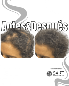 Antes y después de una micropigmentación capilar para un camuflaje de densidad o mujeres en Turquía en SHIFT Hair en Estambul 15 3