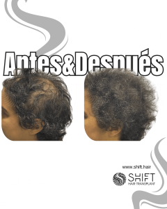 Antes y después de una micropigmentación capilar para un camuflaje de densidad o mujeres en Turquía en SHIFT Hair en Estambul 16 3