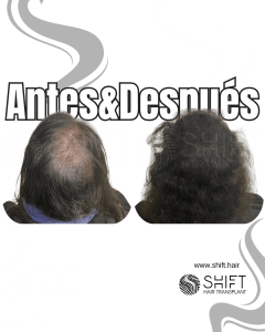 Antes y después de una micropigmentación capilar para un camuflaje de densidad o mujeres en Turquía en SHIFT Hair en Estambul 17 3