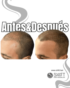 Antes y después de una micropigmentación capilar para un look afeitado en Turquía en SHIFT Hair en Estambul 01 3