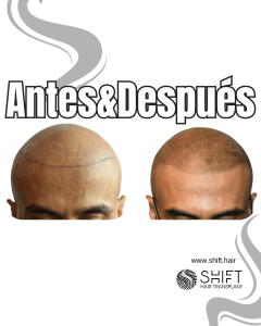 Antes y después de una micropigmentación capilar para un look afeitado en Turquía en SHIFT Hair en Estambul 03 3