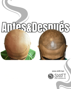 Antes y después de una micropigmentación capilar para un look afeitado en Turquía en SHIFT Hair en Estambul 04 3