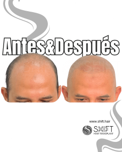 Antes y después de una micropigmentación capilar para un look afeitado en Turquía en SHIFT Hair en Estambul 07 3