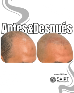 Antes y después de una micropigmentación capilar para un look afeitado en Turquía en SHIFT Hair en Estambul 09 3