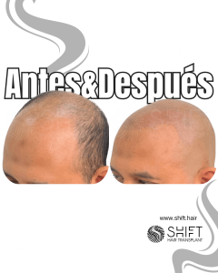 Antes y después de una micropigmentación capilar para un look afeitado en Turquía en SHIFT Hair en Estambul 10 3